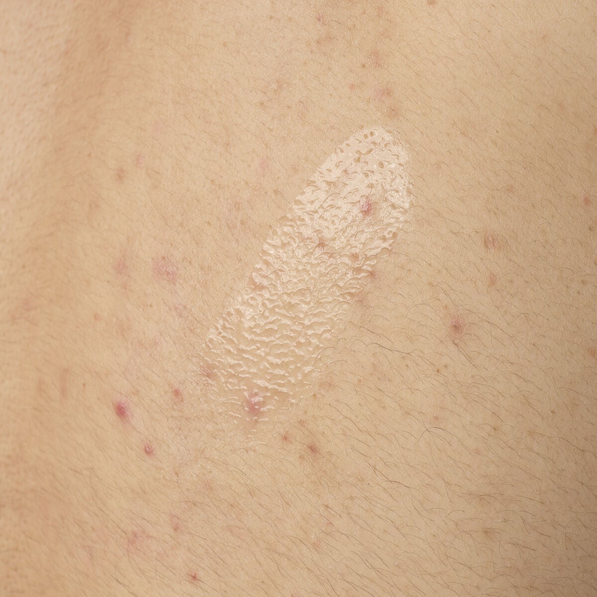 salicylic-acid-0-5-body-serum-s1 ORD-salicylic-acid-05-body-240ml-application.jpg