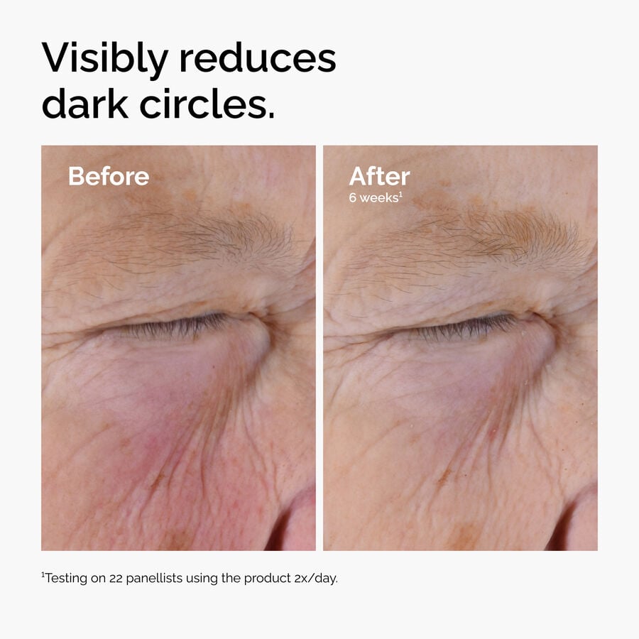 caffeine-solution-5-egcg-eye-serum-a1 ord-caffeine-solution-egcg-dark-circles-before-after.jpg