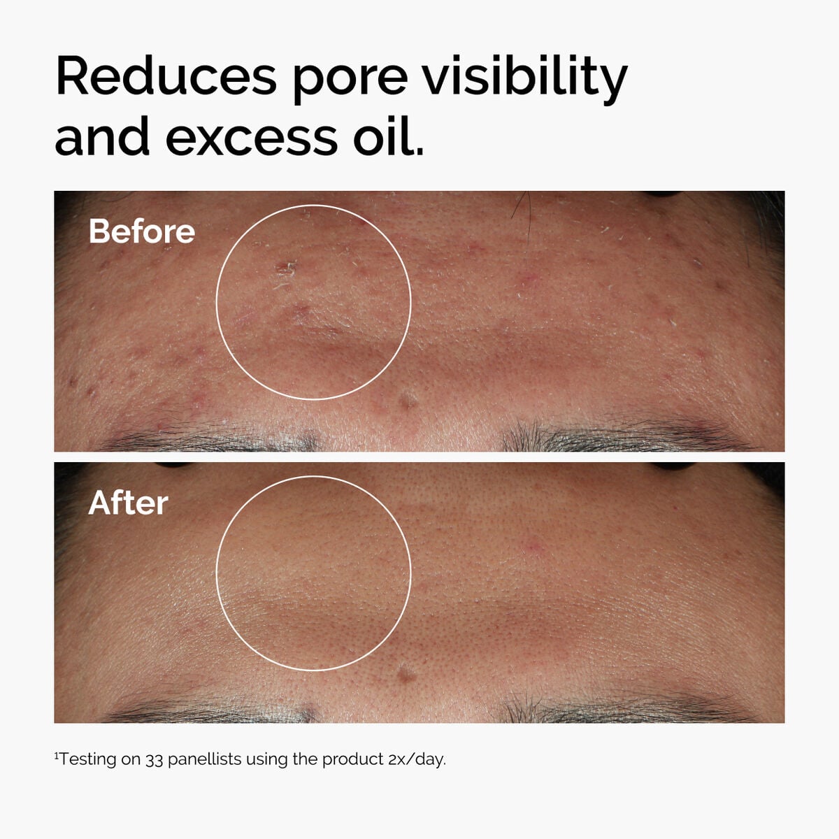 niacinamide-10-zinc-1-b5 ord-niacinamide-zinc-blemish-serum-before-after-pores.jpg