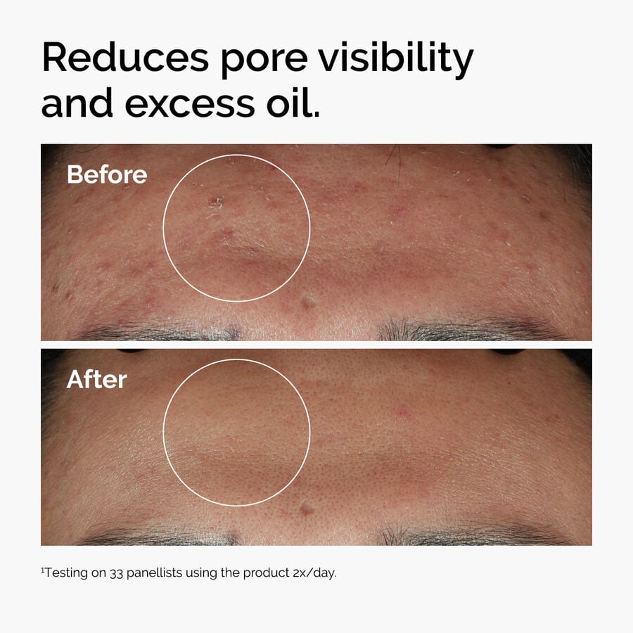 niacinamide-10-zinc-1-b5 ord-niacinamide-zinc-blemish-serum-before-after-pores.jpg