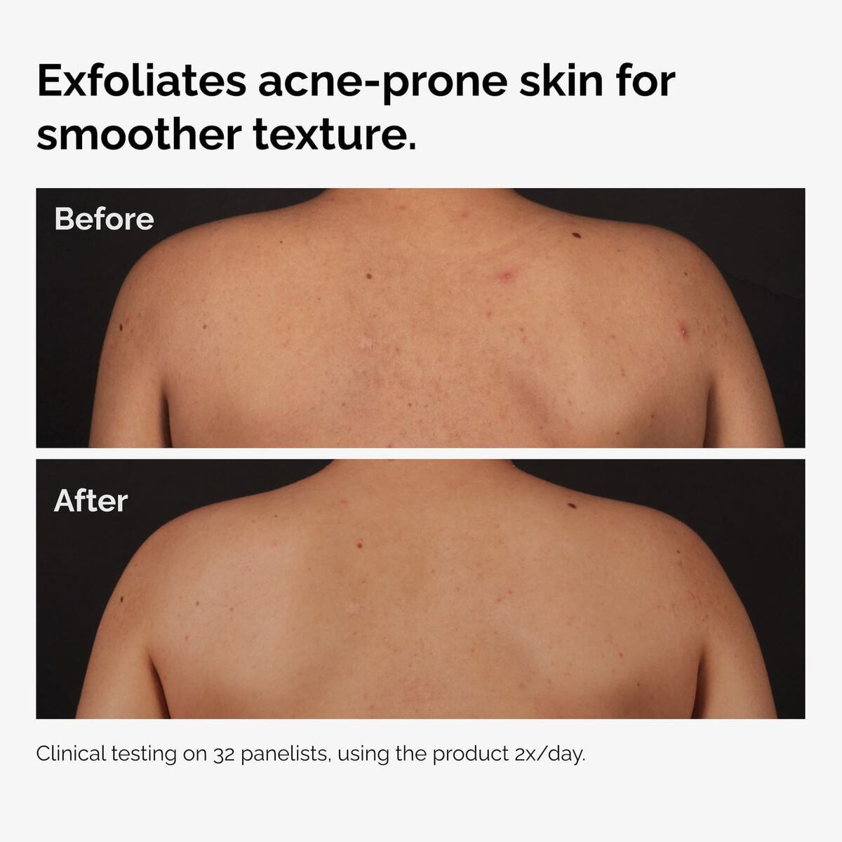 salicylic-acid-0-5-body-serum-s1 ord-salicylic-acid-body-serum-before-after-graphic-NA.jpg